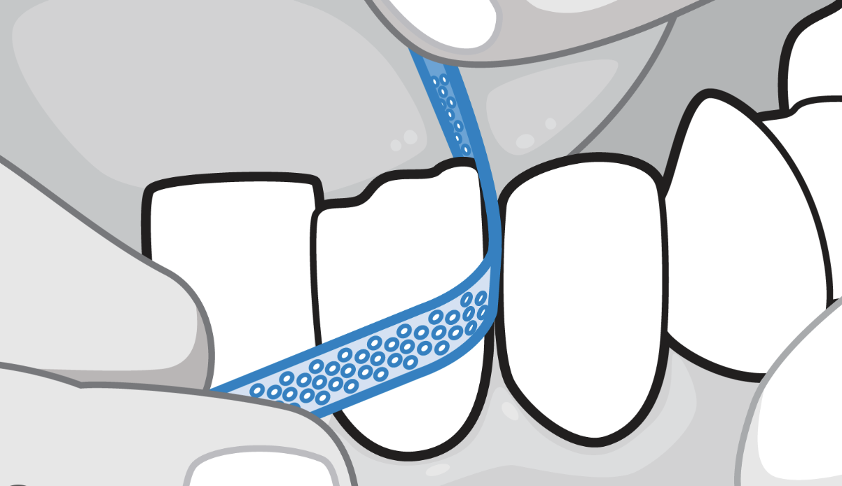 Does Interproximal Reduction Hurt? Understanding IPR in Invisible